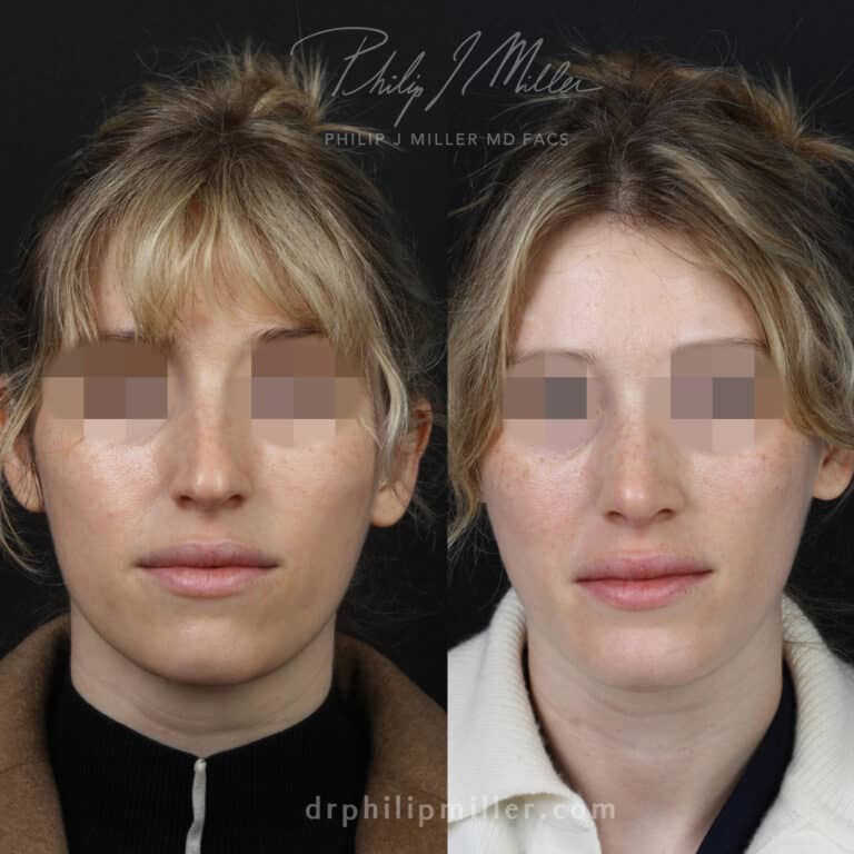 Rhinoplasty and chin implant by Dr. Miller