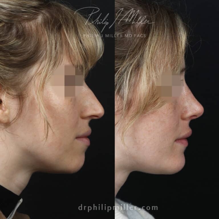 Rhinoplasty and chin implant by Dr. Miller