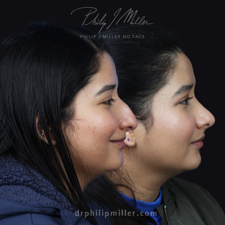 Rhinoplasty to smooth bridge and lift the tip by Dr. Miller