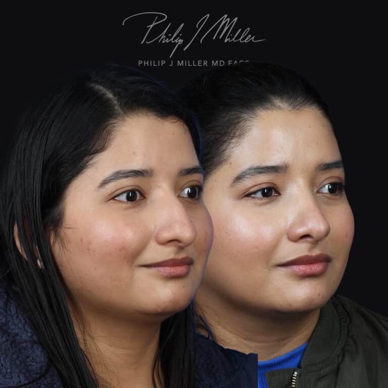 Rhinoplasty to smooth bridge and lift the tip by Dr. Miller