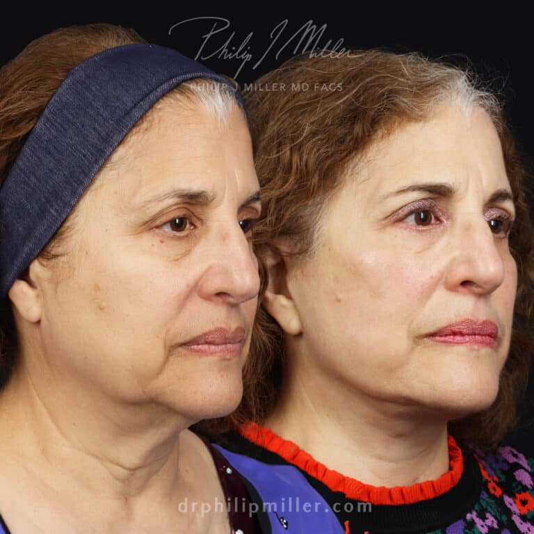 Facelift to tighten loose skin and jowls by Dr. Miller
