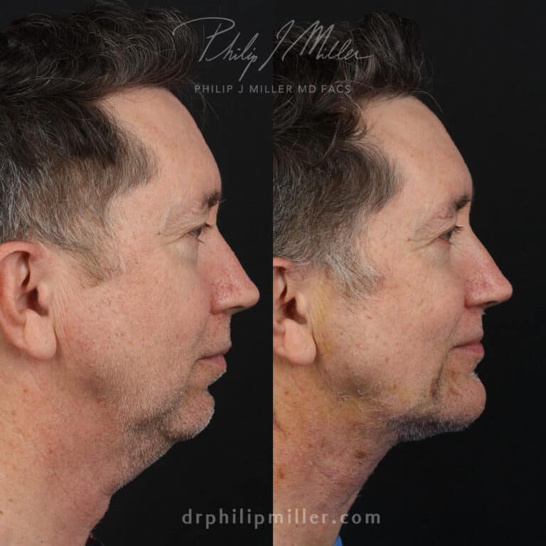 Male facelift 1 week post-op by Dr. Miller