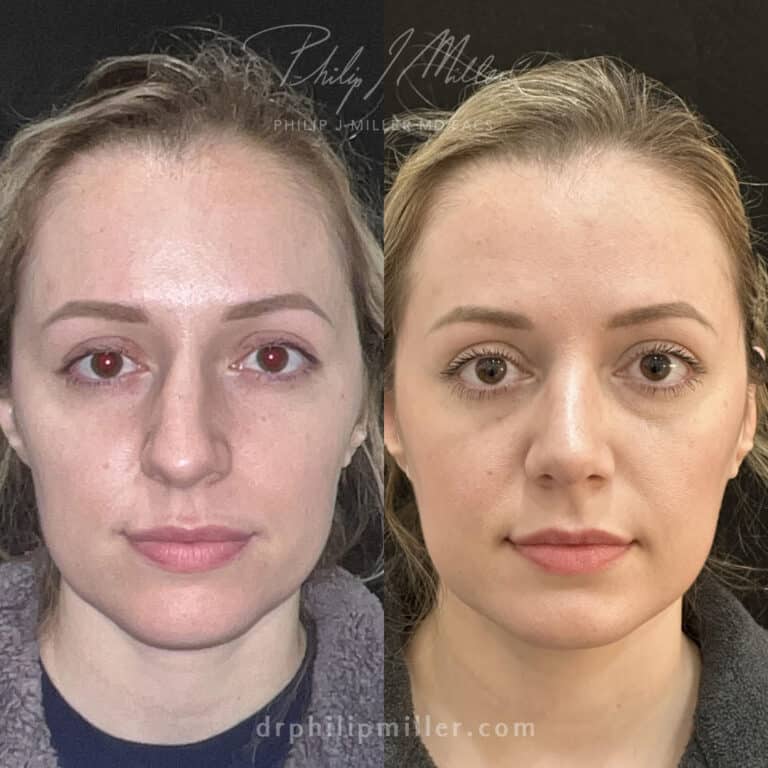 Rhinoplasty 3 weeks post-op by Dr. Miller