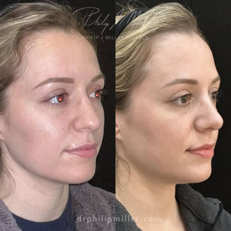 Rhinoplasty 3 weeks post-op by Dr. Miller