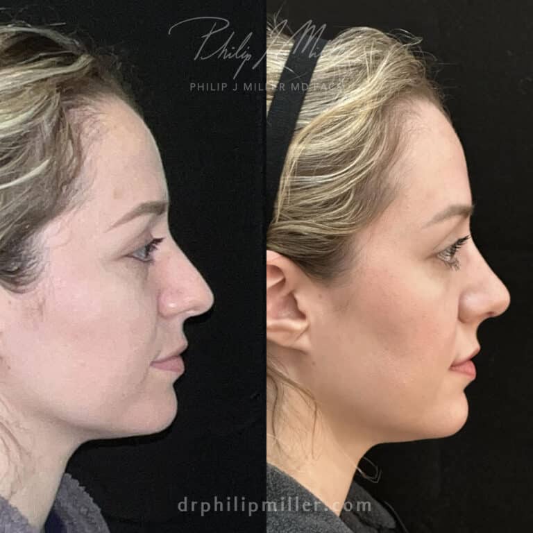 Rhinoplasty 3 weeks post-op by Dr. Miller