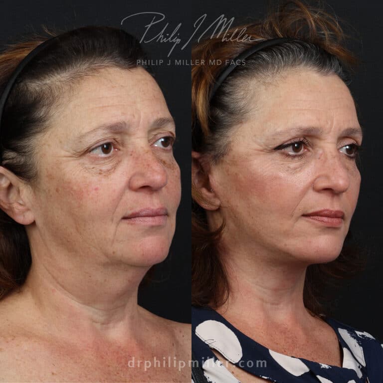 Facelift to rejuvenate the face and tighten jawline by Dr. Miller