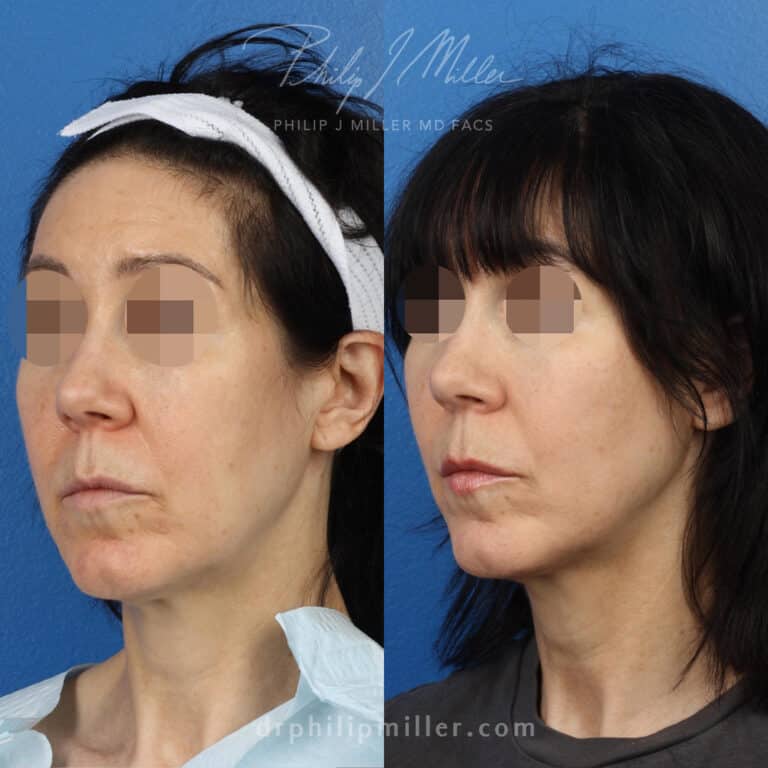 Microlift to tighten skin and rejuvenate appearance by Dr. Miller