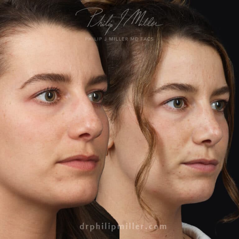 Female rhinoplasty to straighten the bridge by Dr. Miller
