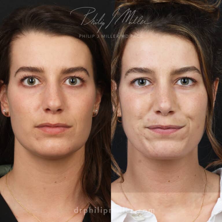 Female rhinoplasty to straighten the bridge by Dr. Miller