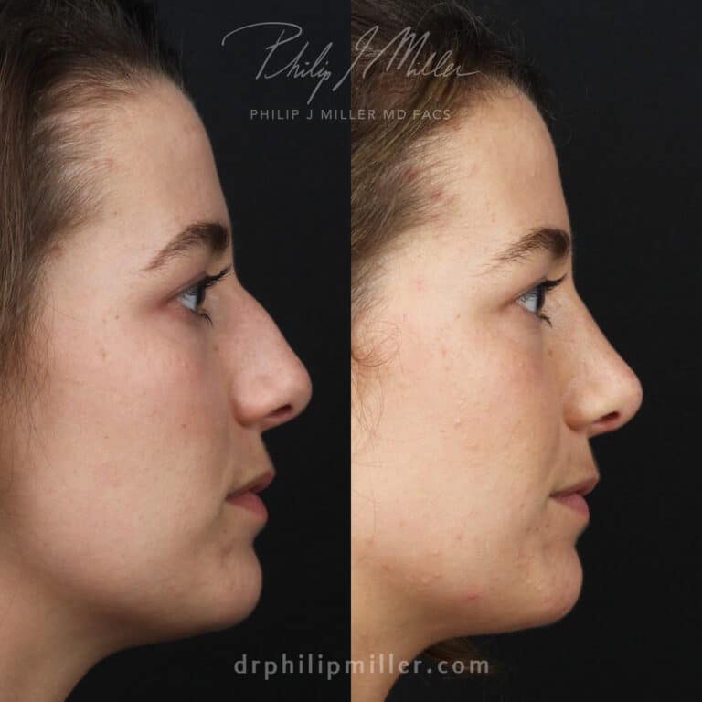 Female rhinoplasty to straighten the bridge by Dr. Miller