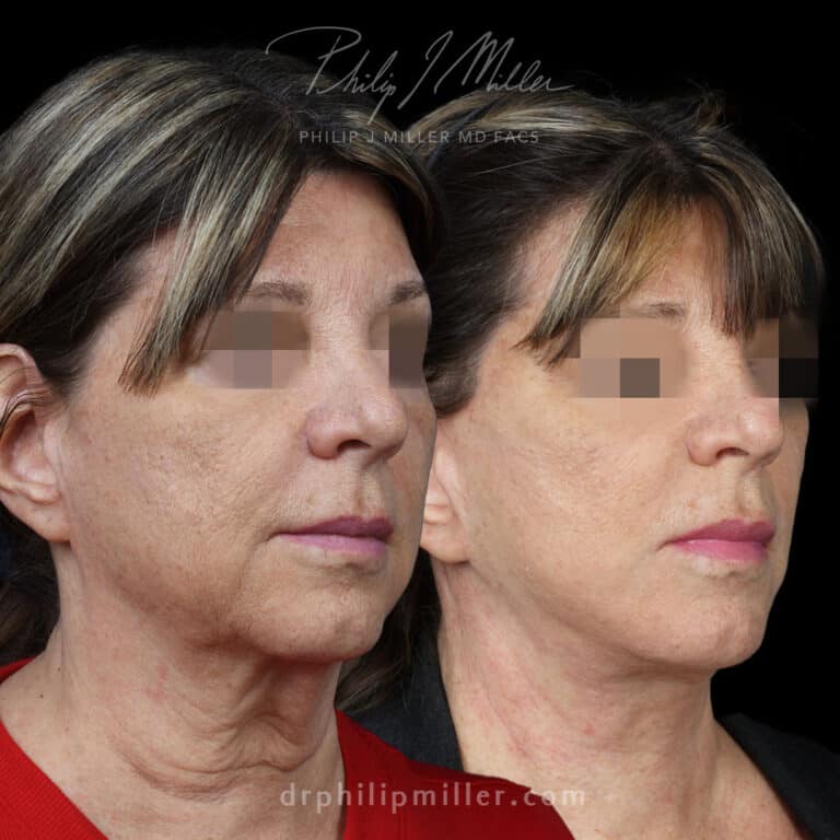 Facelift to Enhance the Lower Face, Jawline, and Neck Area Before and After