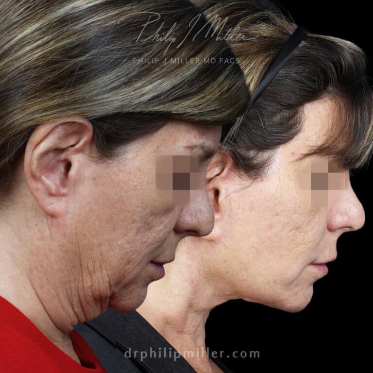 Facelift to Enhance the Lower Face, Jawline, and Neck Area Before and After