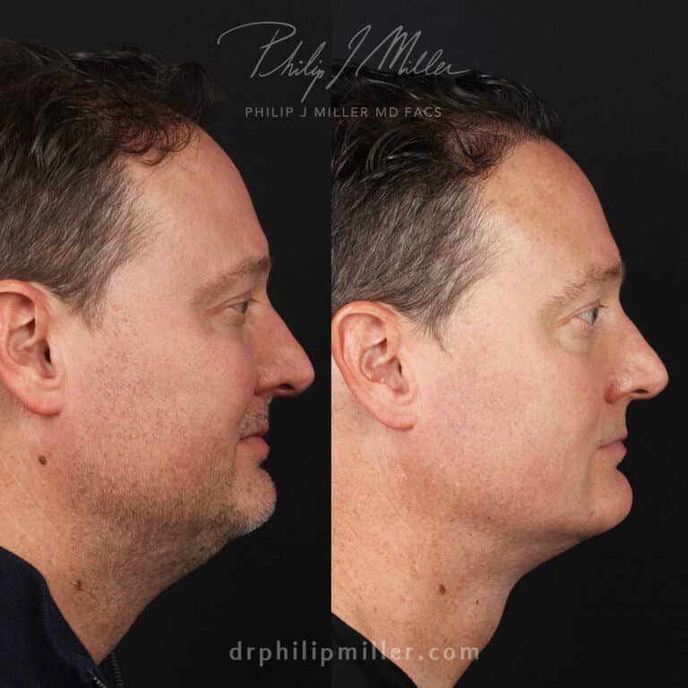 Neck Lift to Enhance the Neck and Jawline Before and After