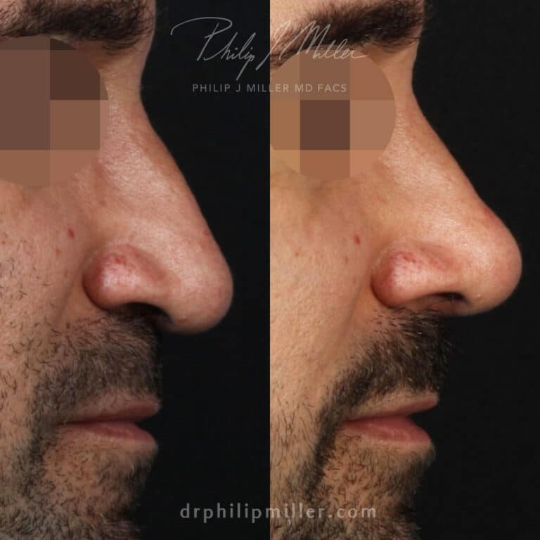 Rhinoplasty to Improve the Nasal Bridge and Lift the Nasal Tip Before and After