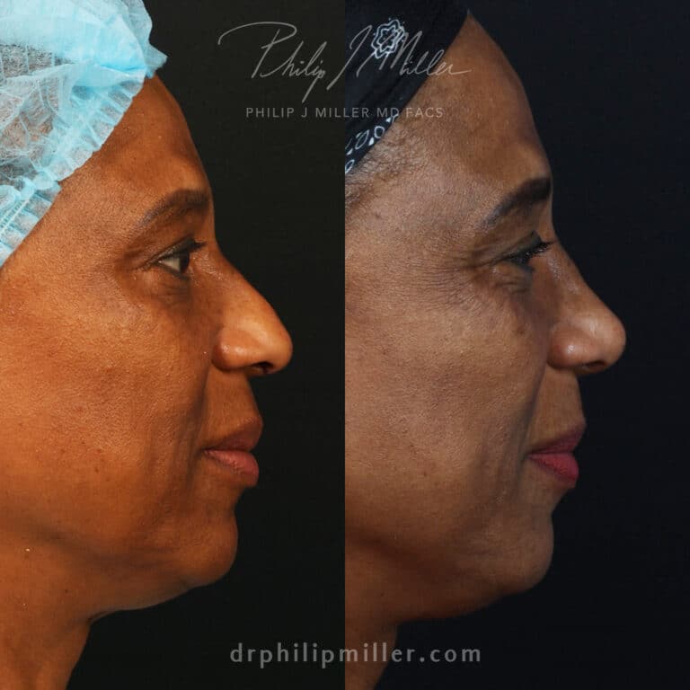 Ethnic Rhinoplasty to Smooth the Nasal Bridge and Tip Before and After