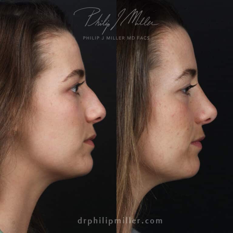 Nine Months Post-Rhinoplasty to Correct Dorsal Hump and Nasal Tip Before and After