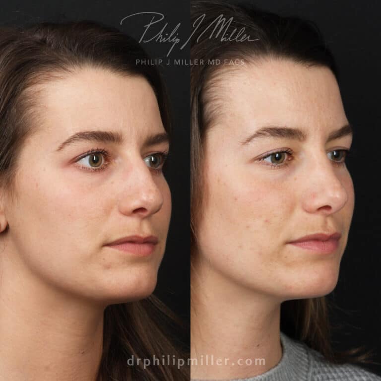 Nine Months Post-Rhinoplasty to Correct Dorsal Hump and Nasal Tip Before and After
