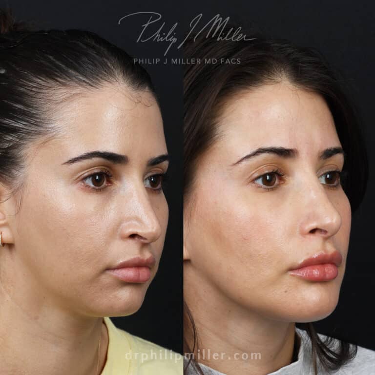 Rhinoplasty and Chin Augmentation for More Balanced Features Before and After
