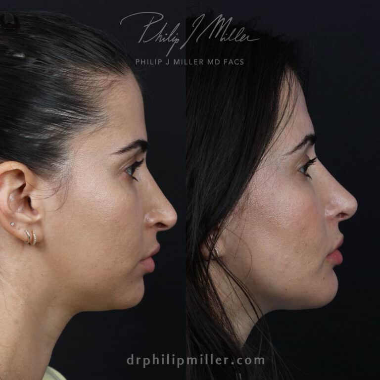 Rhinoplasty and Chin Augmentation for More Balanced Features Before and After