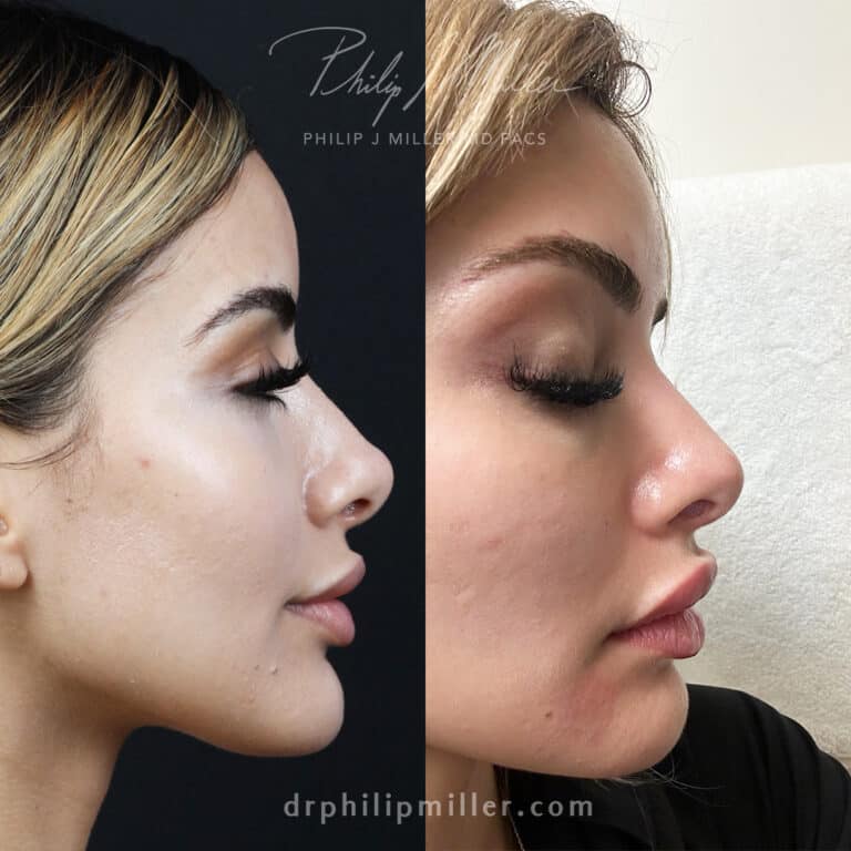 Rhinoplasty to Straighten Nasal Bridge and Improve Nasal Tip Before and After