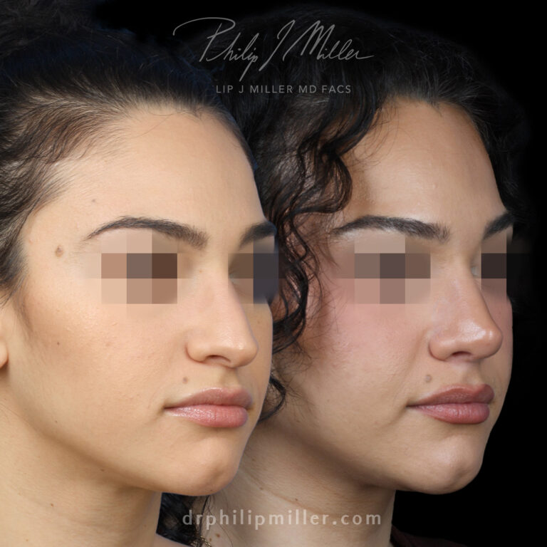 Rhinoplasty to Lift Nasal Tip and Reduce the Hump Before and After