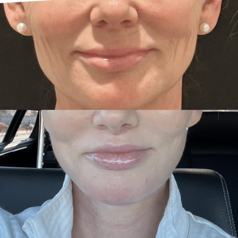 Lip Lift to Enhance the Lips Before and After
