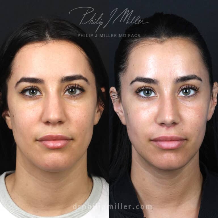 Lip Lift and Rhinoplasty Before and After