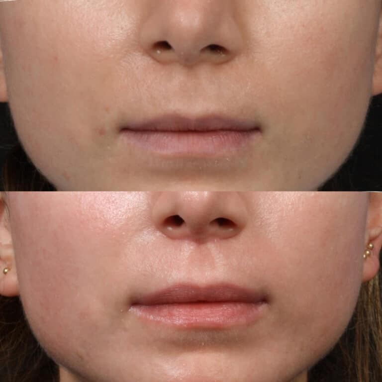 Lip Lift for a Fuller Upper Lip Before and After