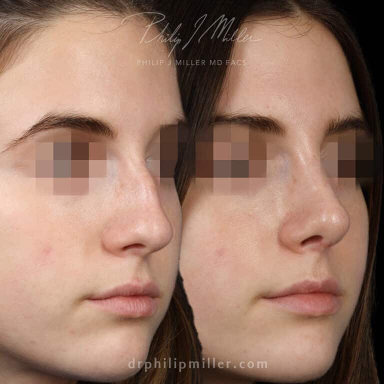 Rhinoplasty to Remove Dorsal Hump Before and After