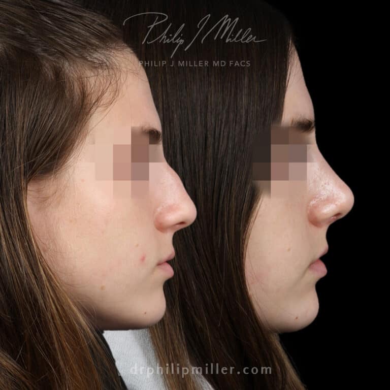 Rhinoplasty to Remove Dorsal Hump Before and After