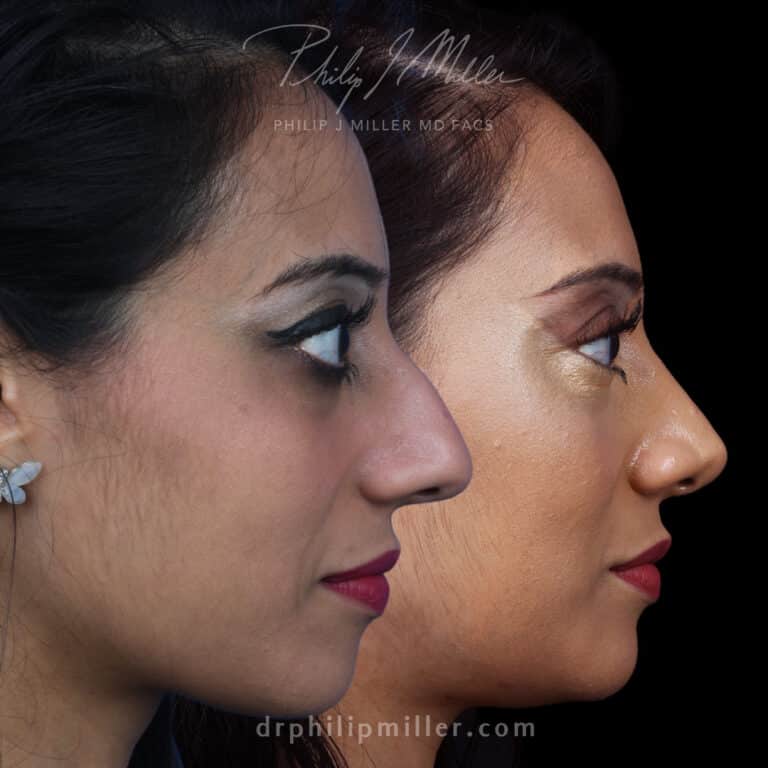 Rhinoplasty 8 Years Later Before and After