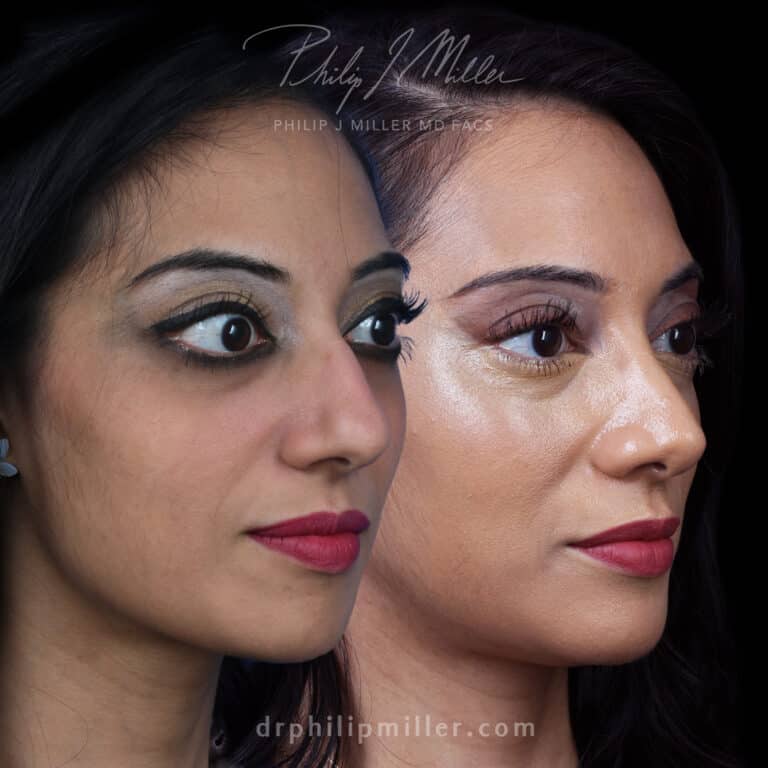 Rhinoplasty 8 Years Later Before and After