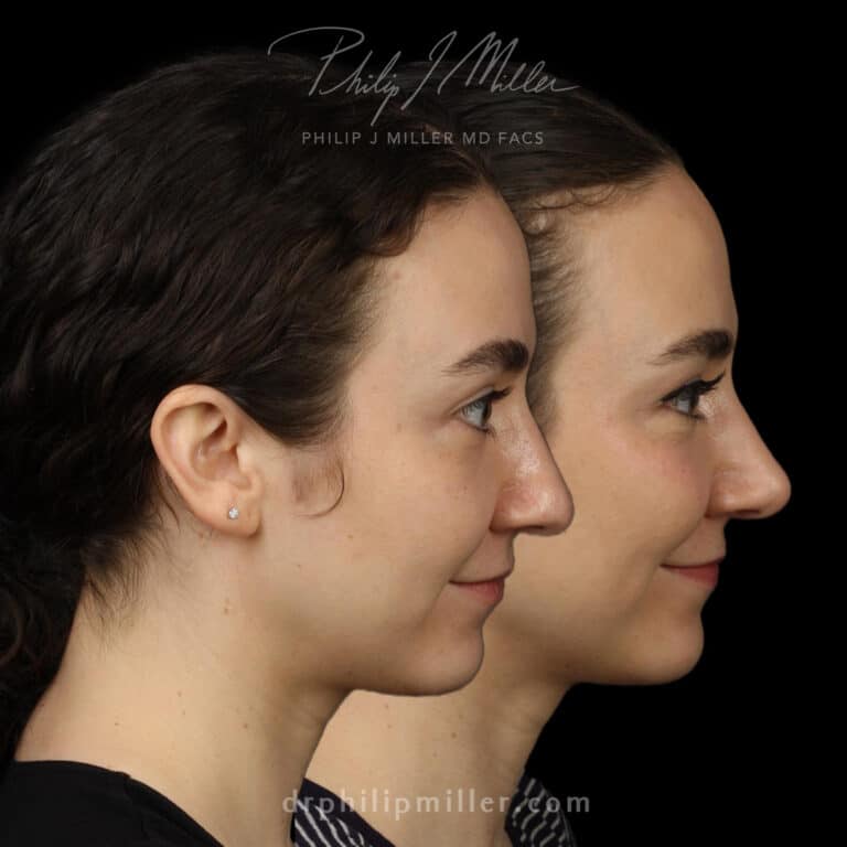Tip Plasty to Refine the Nasal Tip and Enhance the Facial Profile Before and After