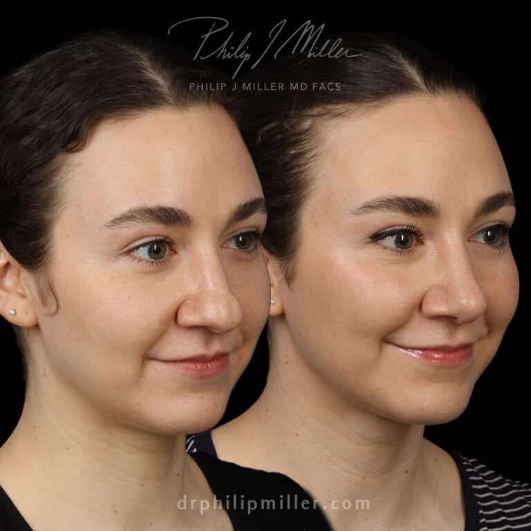 Tip Plasty to Refine the Nasal Tip and Enhance the Facial Profile Before and After