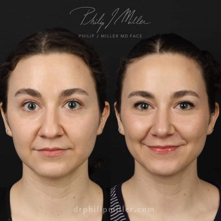 Tip Plasty to Refine the Nasal Tip and Enhance the Facial Profile Before and After