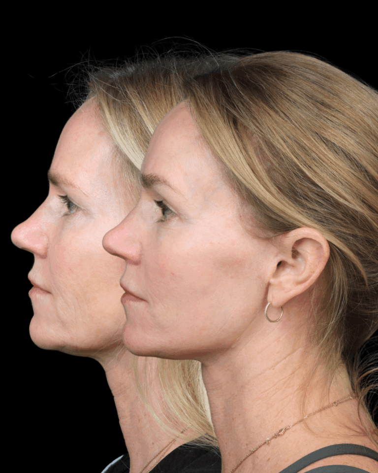Deep Plane Face & Neck Lift With Brow Lift for Natural Rejuvenation