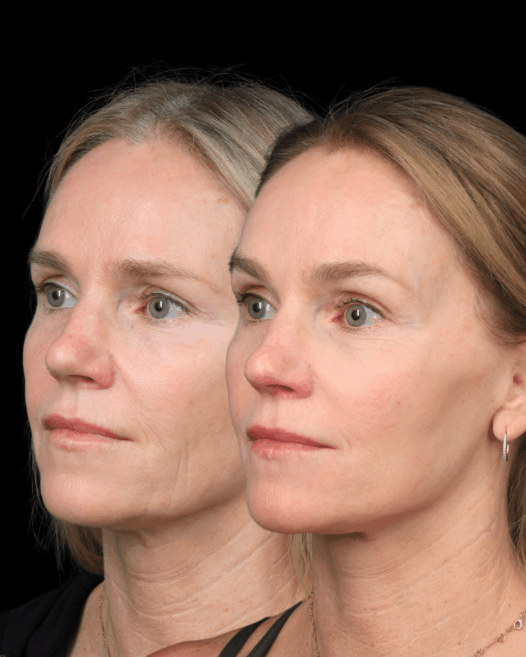 Deep Plane Face & Neck Lift With Brow Lift for Natural Rejuvenation