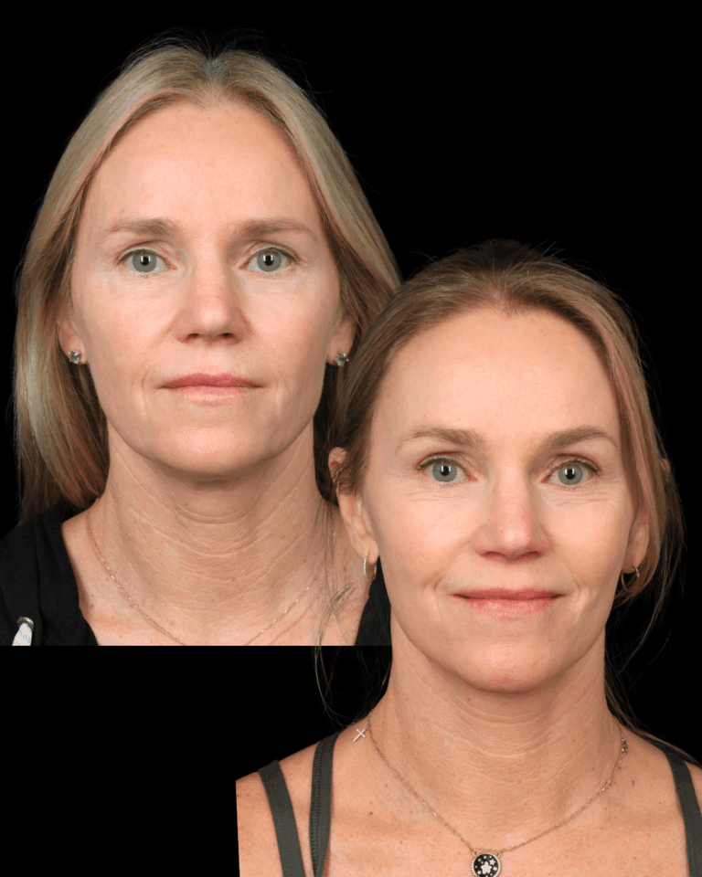 Deep Plane Face & Neck Lift With Brow Lift for Natural Rejuvenation