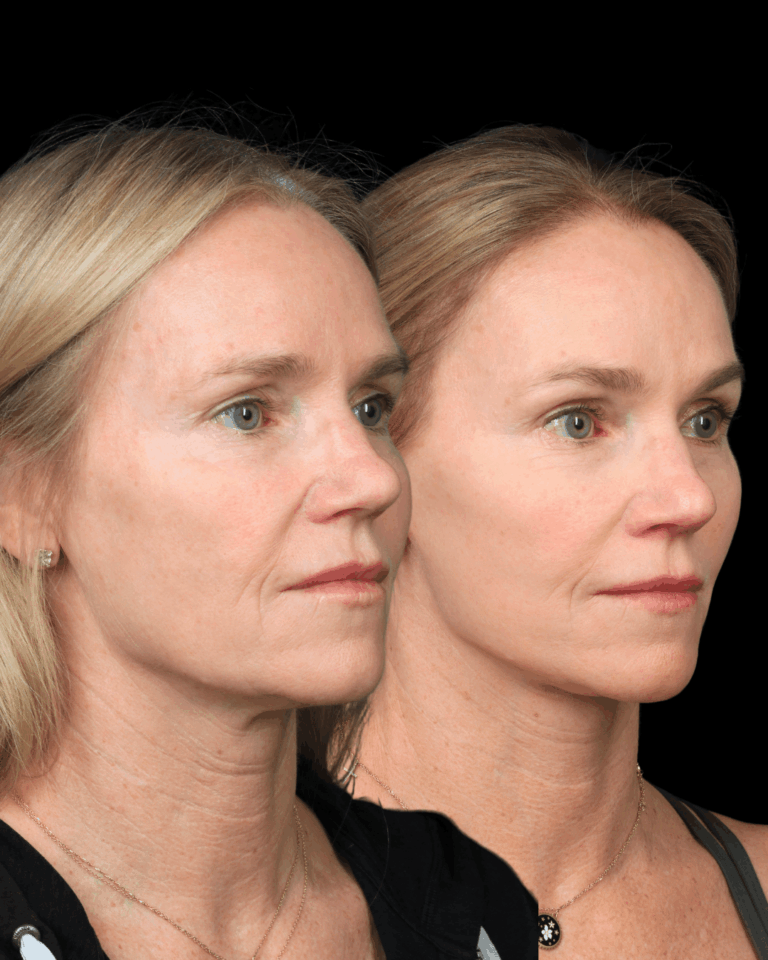 Deep Plane Face & Neck Lift With Brow Lift for Natural Rejuvenation