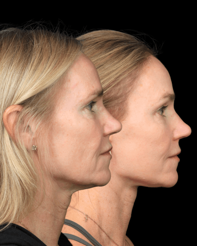 Deep Plane Face & Neck Lift With Brow Lift for Natural Rejuvenation